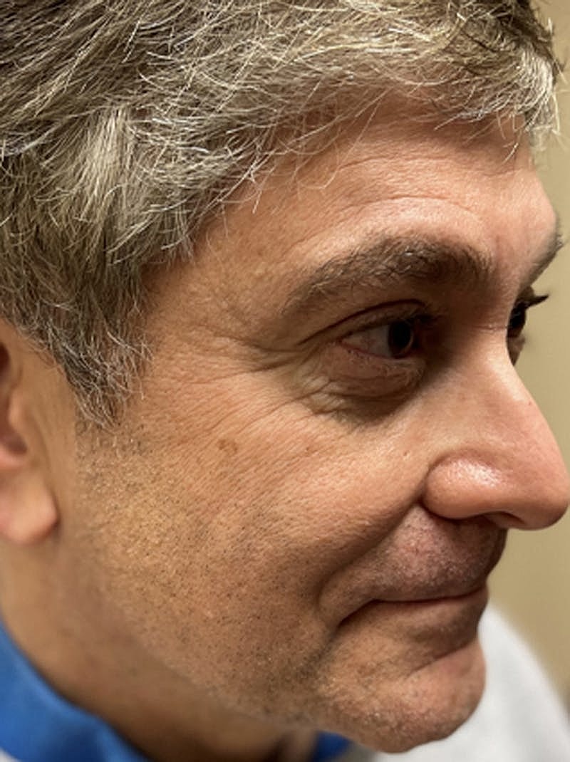 Botox Dysport Before & After