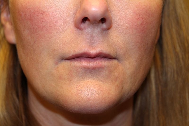 Botox Dysport Gallery Before & After