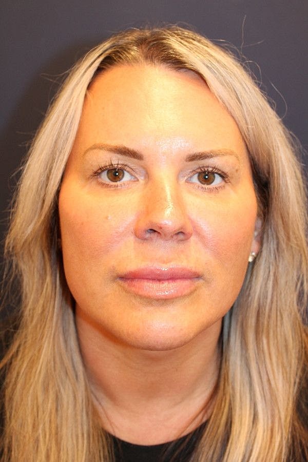 Botox Dysport Gallery Before & After