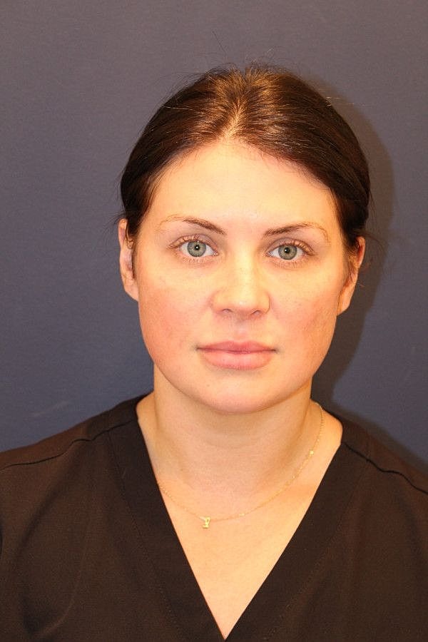 Botox Dysport Gallery Before & After