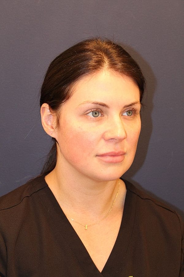 Botox Dysport Gallery Before & After