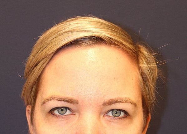 Botox Dysport Gallery Before & After