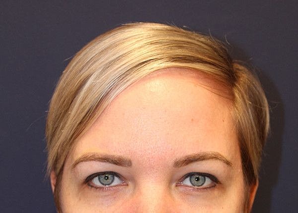 Botox Dysport Gallery Before & After