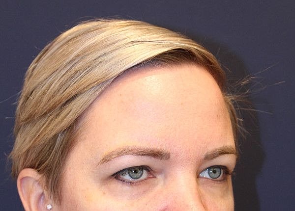 Botox Dysport Gallery Before & After