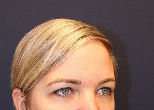 Botox Dysport Gallery Before & After