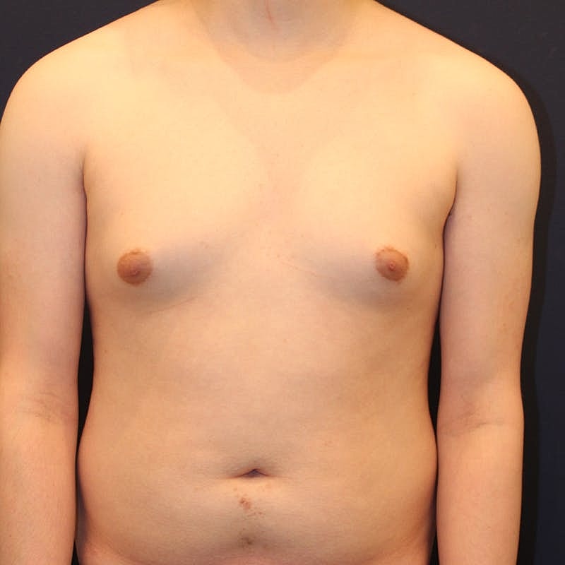 Male Breast Reduction Gynecomastia Before & After