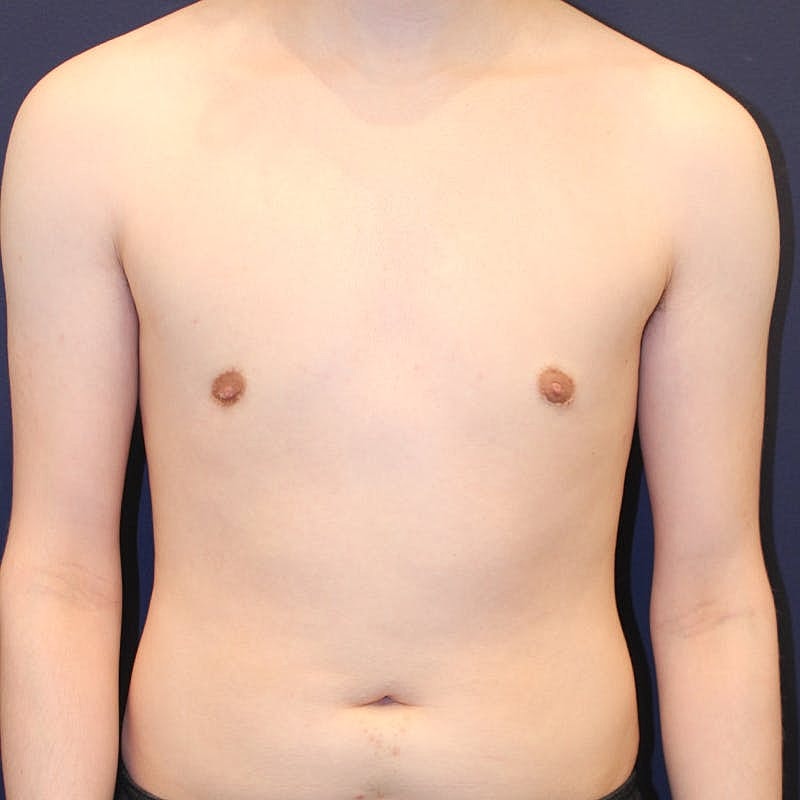 Male Breast Reduction Gynecomastia Before & After