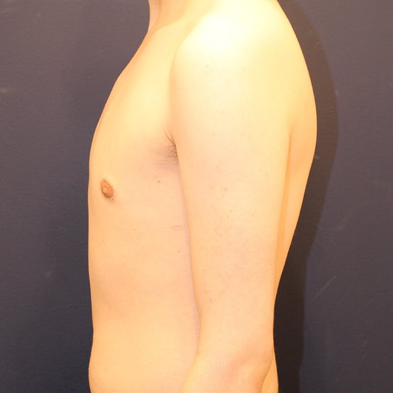 Male Breast Reduction Gynecomastia Before & After