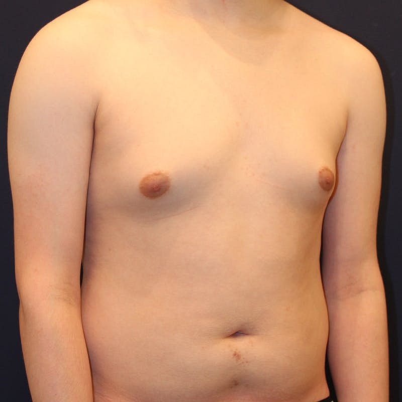 Male Breast Reduction Gynecomastia Before & After