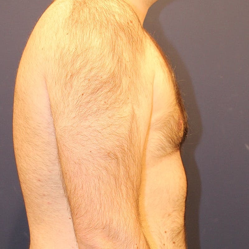 Male Breast Reduction Gynecomastia Before & After