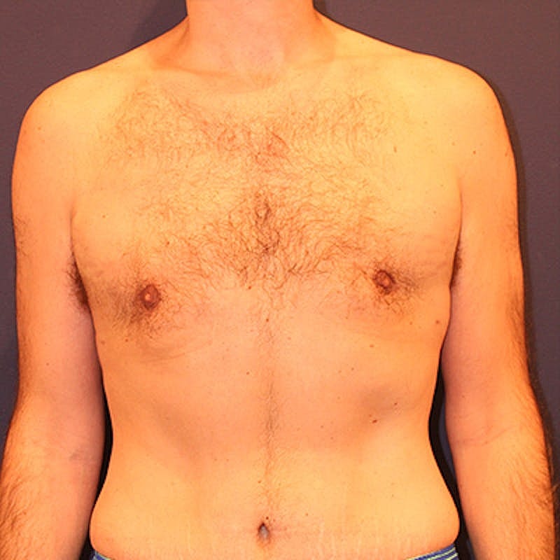 Male Breast Reduction Gynecomastia Before & After