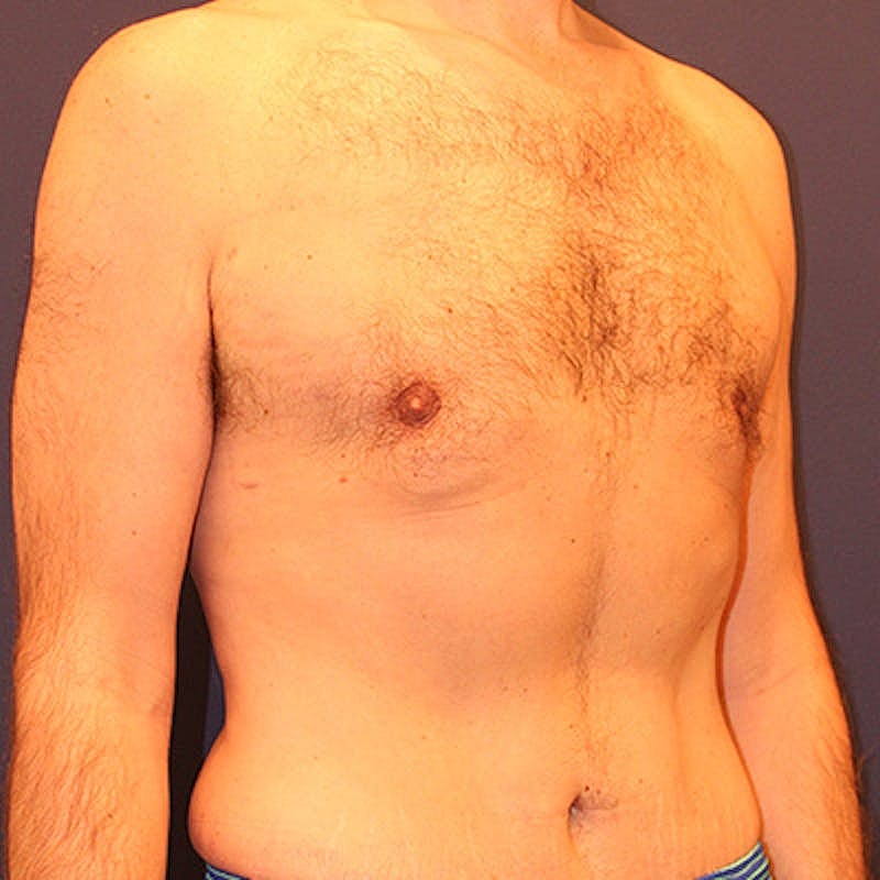 Male Breast Reduction Gynecomastia Before & After