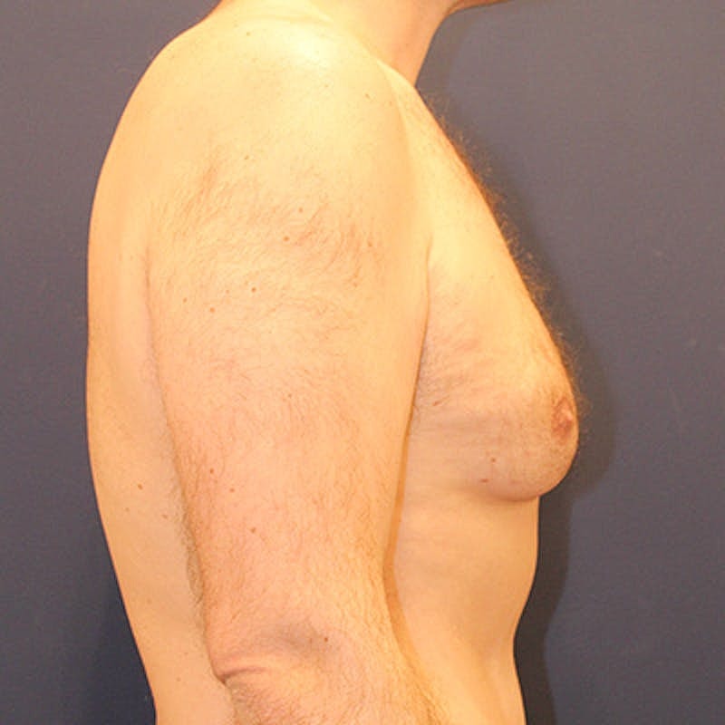 Male Breast Reduction Gynecomastia Before & After