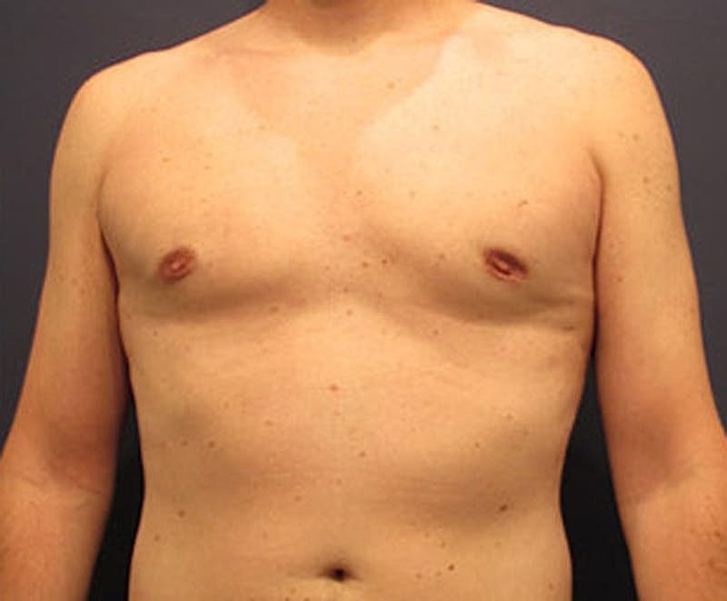 Male Breast Reduction Gynecomastia Before & After