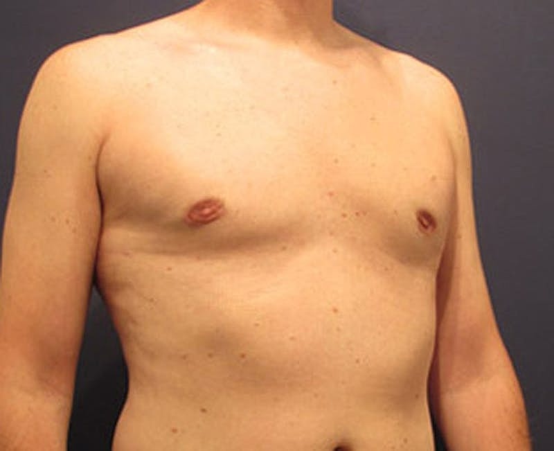 Male Breast Reduction Gynecomastia Before & After