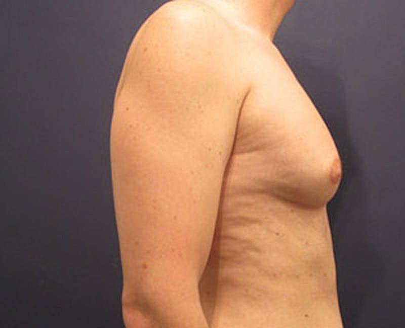 Male Breast Reduction Gynecomastia Before & After