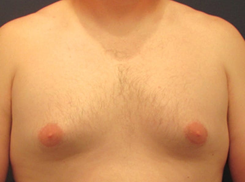 Male Breast Reduction Gynecomastia Before & After