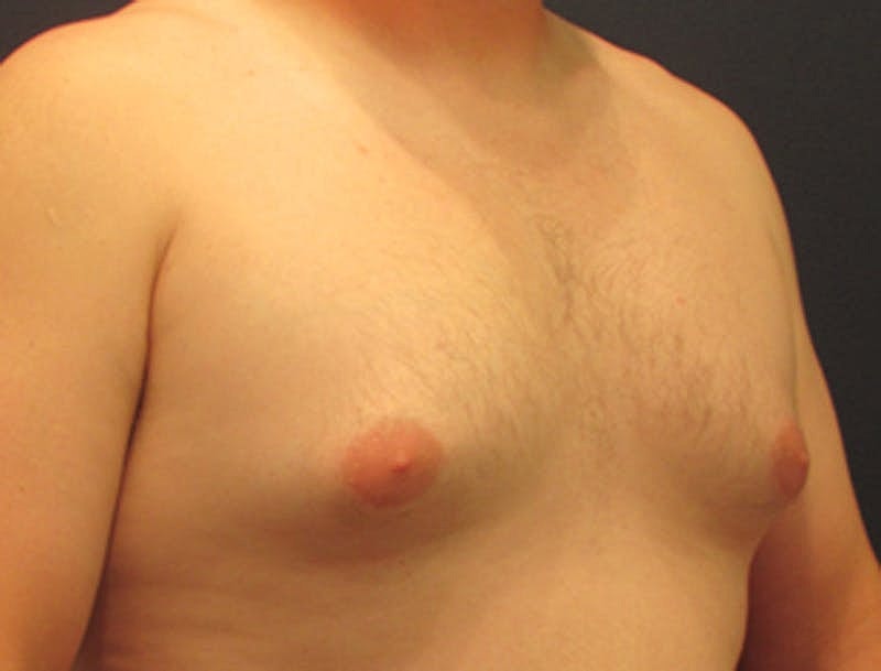 Male Breast Reduction Gynecomastia Before & After