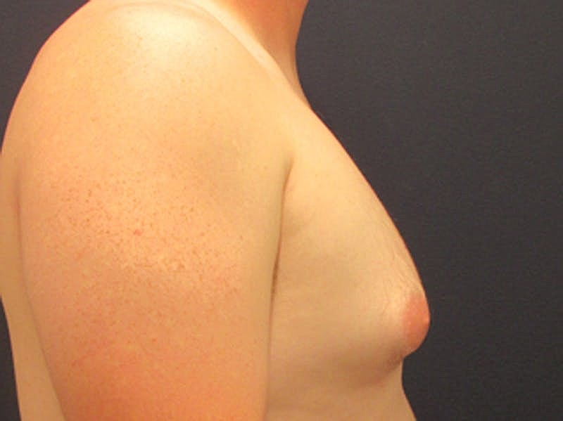 Male Breast Reduction Gynecomastia Before & After