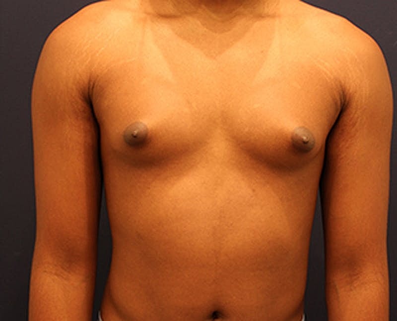 Male Breast Reduction Gynecomastia Before & After