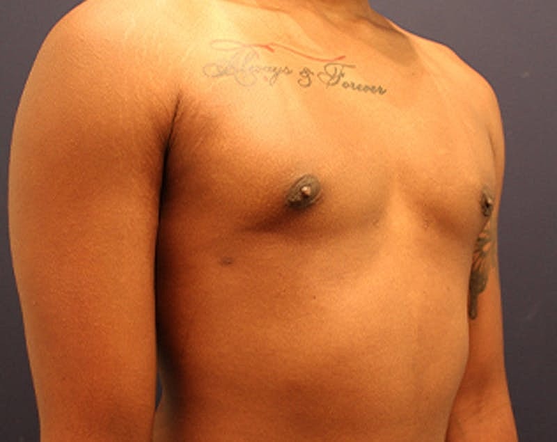 Male Breast Reduction Gynecomastia Before & After