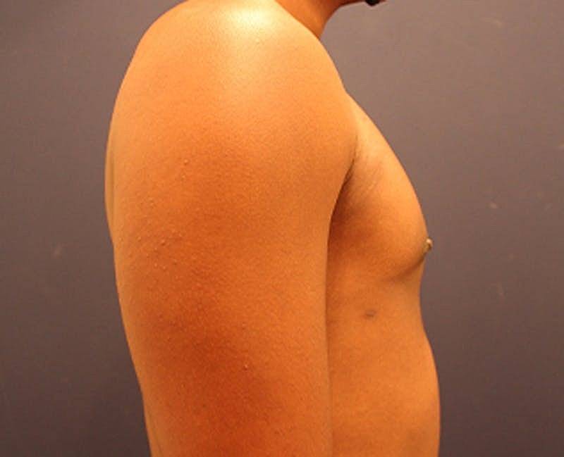 Male Breast Reduction Gynecomastia Before & After