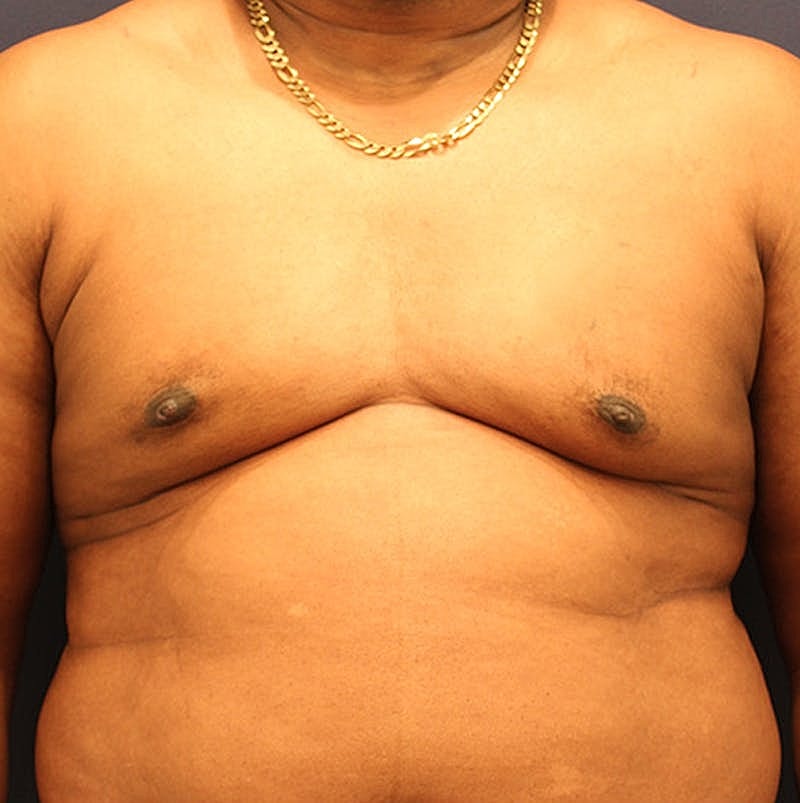 Male Breast Reduction Gynecomastia Before & After