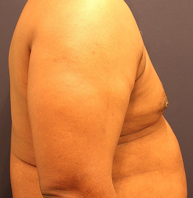 Male Breast Reduction Gynecomastia Before & After