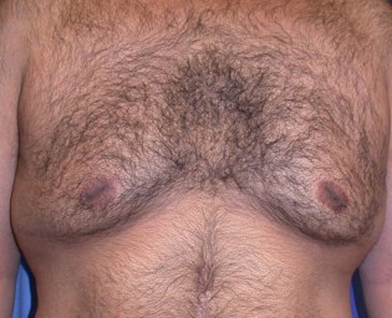 Male Breast Reduction Gynecomastia Before & After