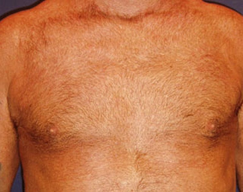 Male Breast Reduction Gynecomastia Before & After