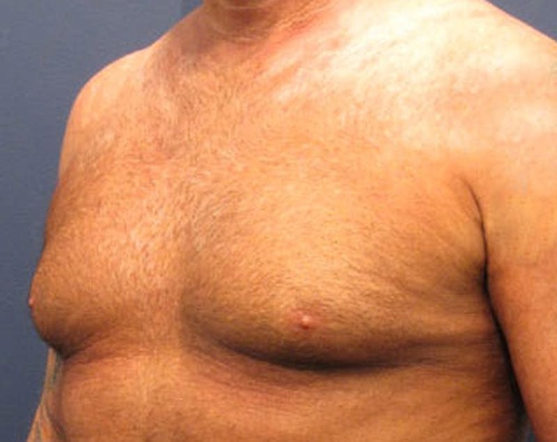 Male Breast Reduction Gynecomastia Before & After