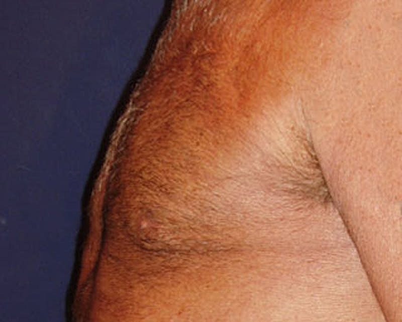 Male Breast Reduction Gynecomastia Before & After