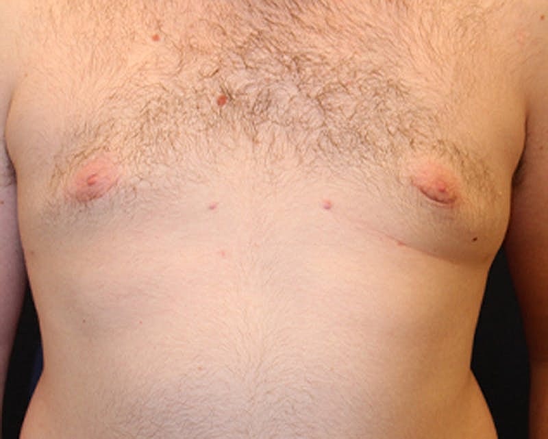 Male Breast Reduction Gynecomastia Before & After