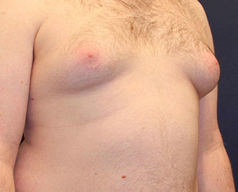 Male Breast Reduction Gynecomastia Before & After