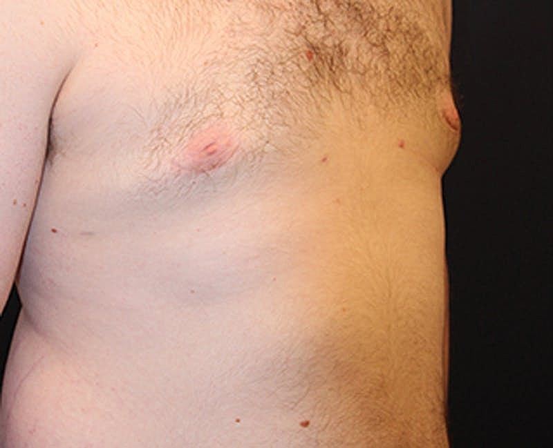 Male Breast Reduction Gynecomastia Before & After