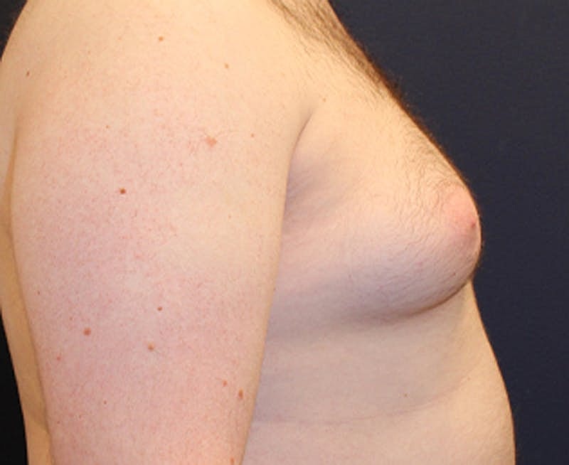 Male Breast Reduction Gynecomastia Before & After