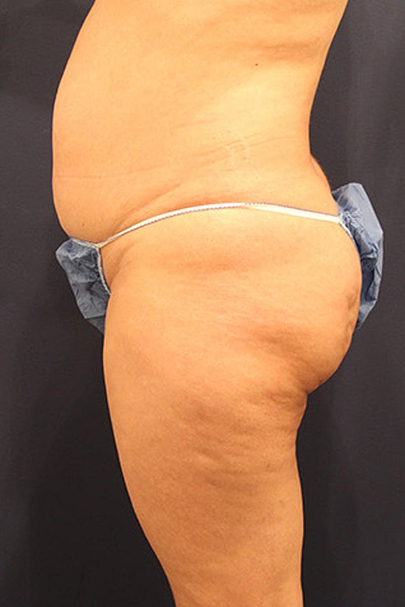 Brazilian Butt Lift Before & After