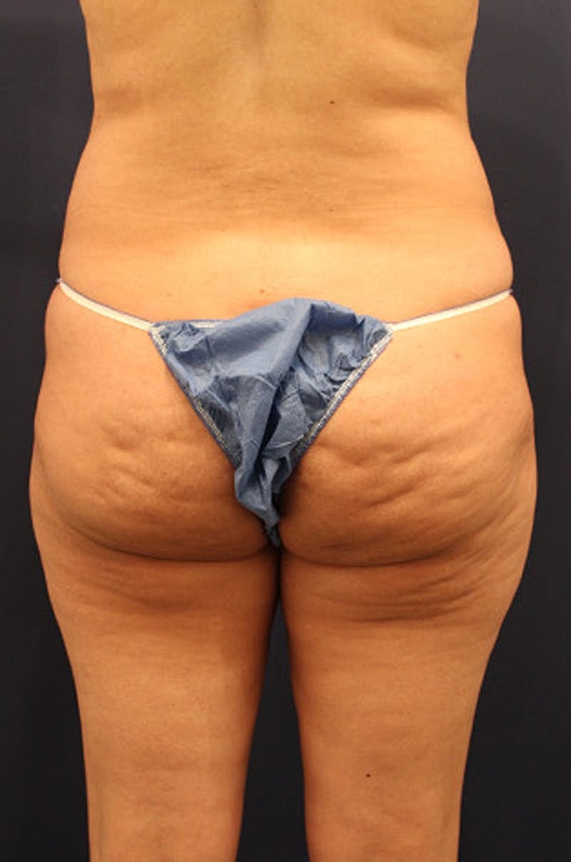 Brazilian Butt Lift Before & After