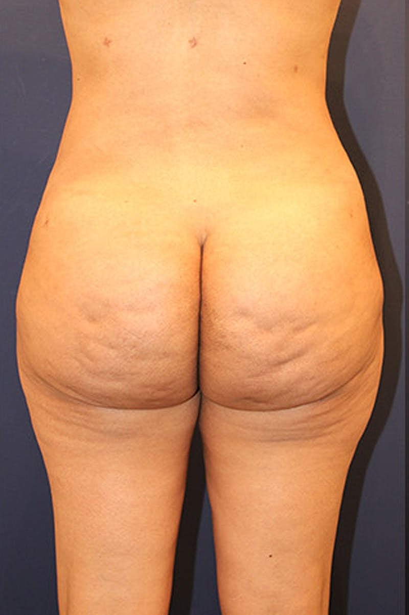 Brazilian Butt Lift Before & After
