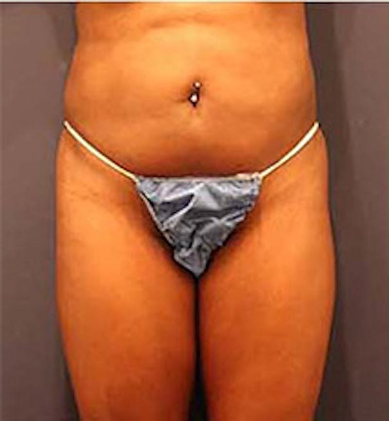 Brazilian Butt Lift Before & After