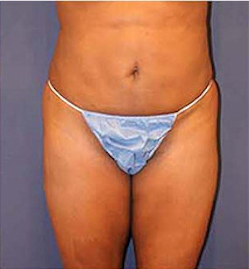 Brazilian Butt Lift Before & After