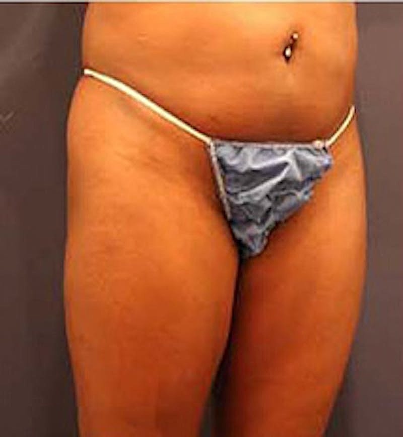 Brazilian Butt Lift Before & After