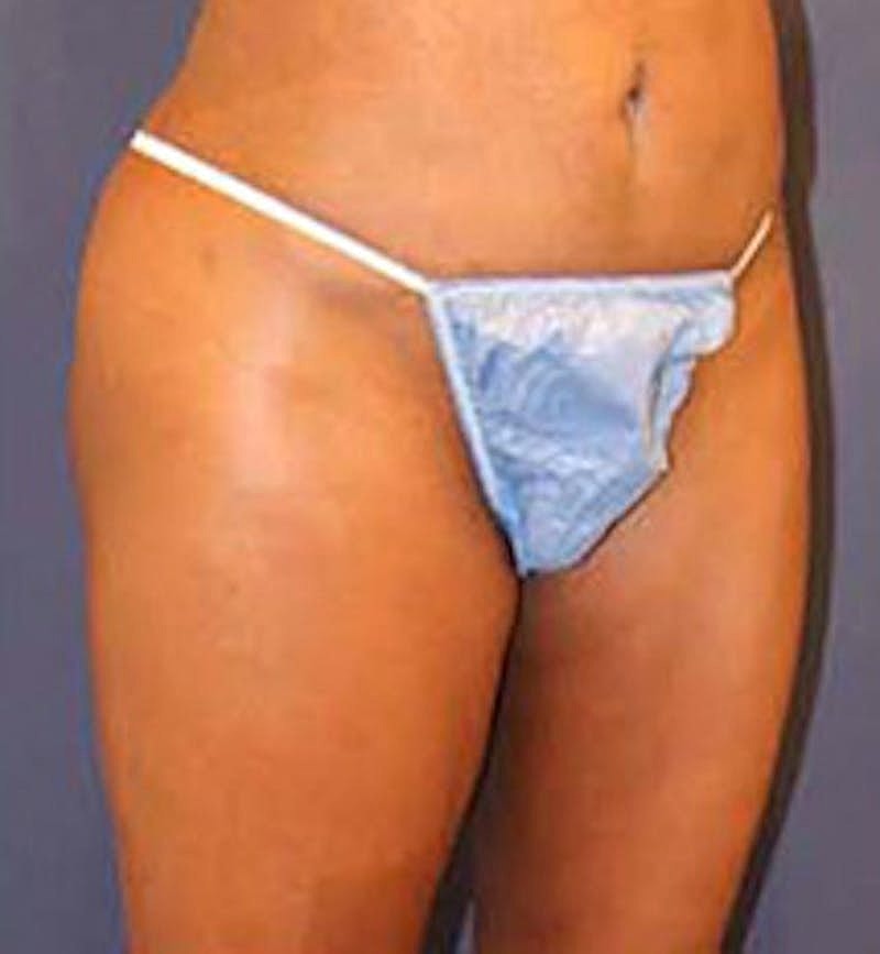 Brazilian Butt Lift Before & After