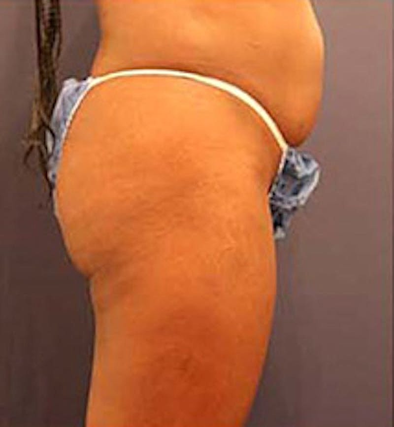 Brazilian Butt Lift Before & After