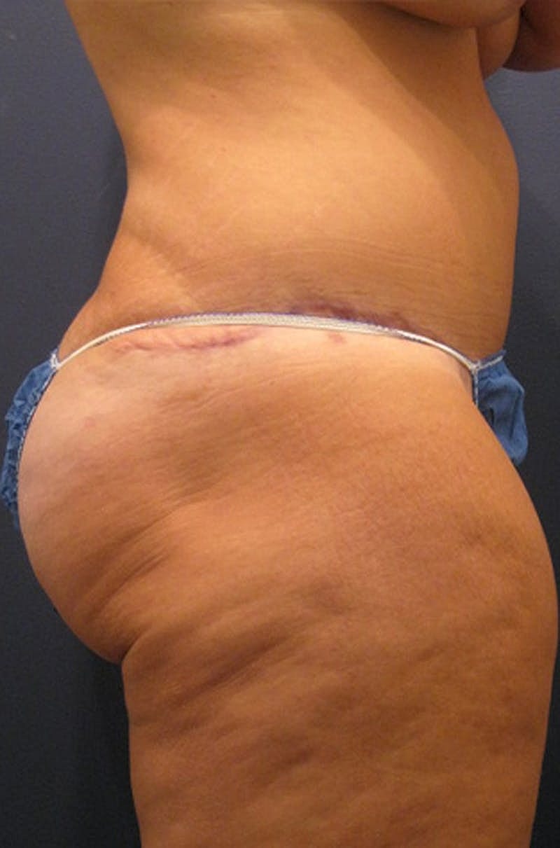 Brazilian Butt Lift Before & After