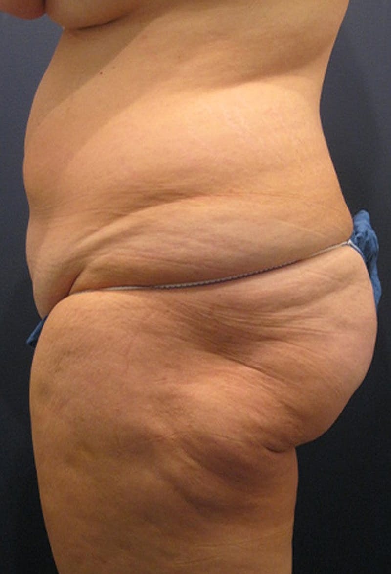 Brazilian Butt Lift Before & After