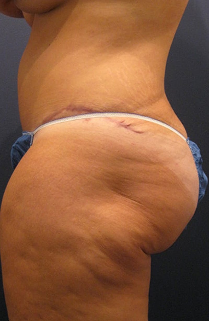 Brazilian Butt Lift Before & After