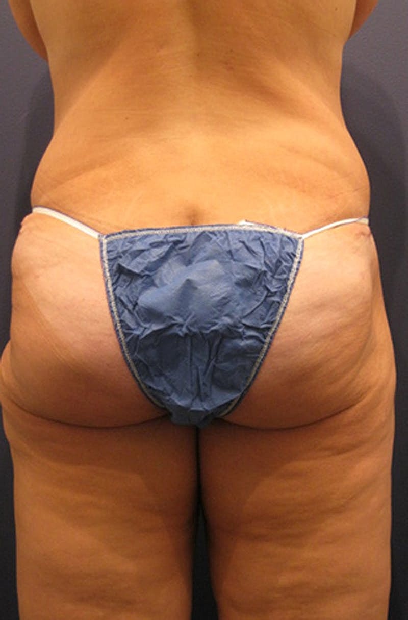 Brazilian Butt Lift Before & After