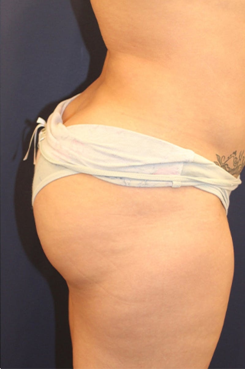 Brazilian Butt Lift Before & After