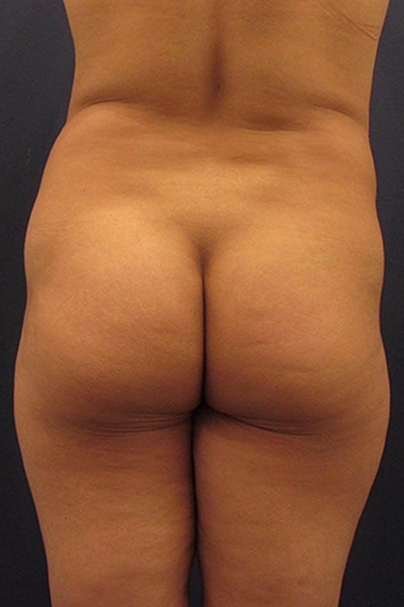 Brazilian Butt Lift Before & After